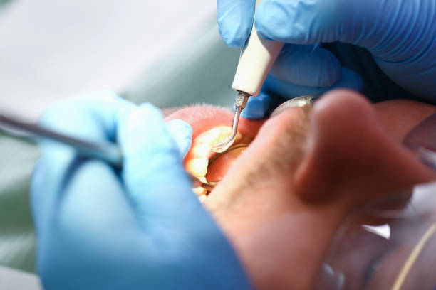 Best Emergency Wisdom Teeth Removal in Weber City, VA