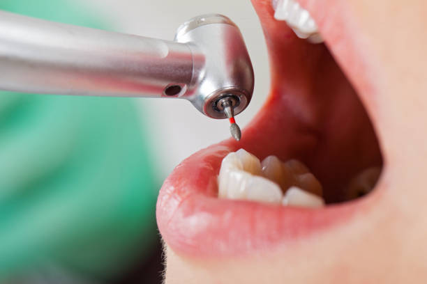 Best Emergency Treatment for Dental Infections or Abscesses in Weber City, VA